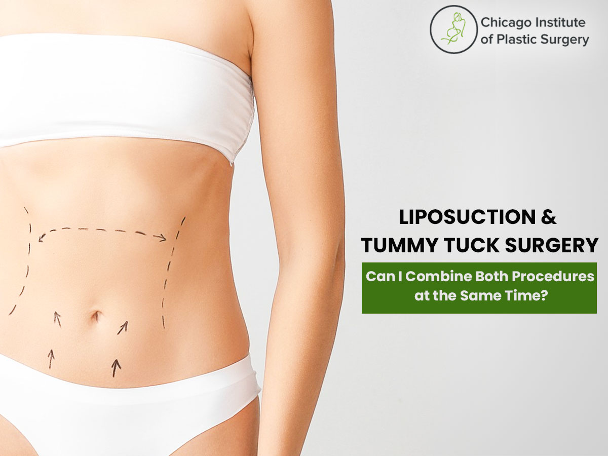 gmb-Liposuction & Tummy Tuck Surgery---Can I Combine Both Procedures at the Same Time