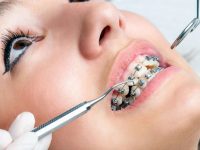 braces-aesthetic-dentistry